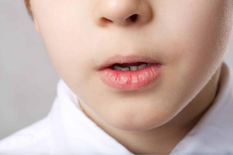 Oddychanie przez usta u dzieci