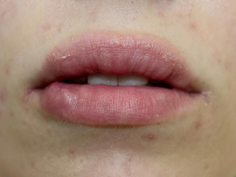 Alternatywy dla powiększania ust w ciąży i podczas karmienia piersią