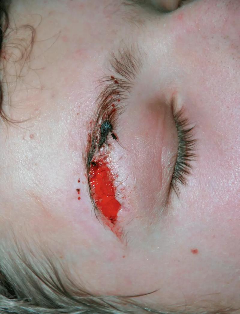 Ocena ciężkości urazu brody