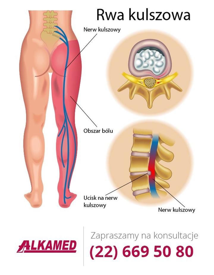 Rwa kulszowa w ciąży